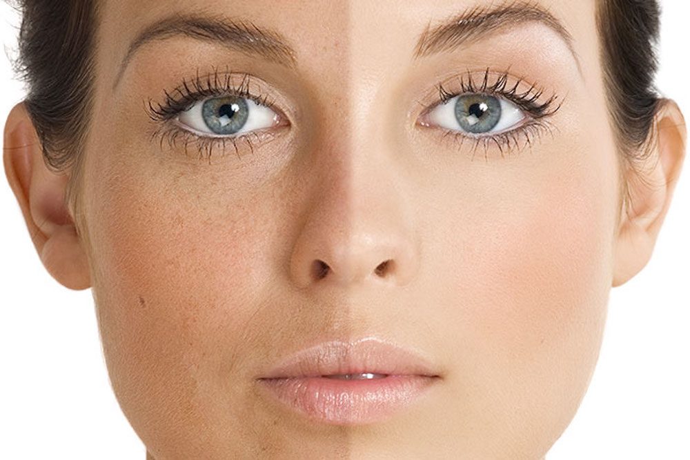 Understanding Skin Pigmentation and Discoloration | Iris Garden - Treatment For Evening Skin Tone Lakeland